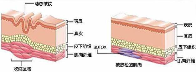 打完除皱针脸会肿吗？