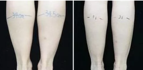 肉毒毒素注射瘦腿前后对比照