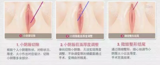 小阴唇整形