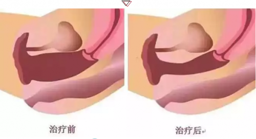术前术后对比图