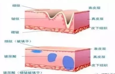 北京美天玻尿酸除皱