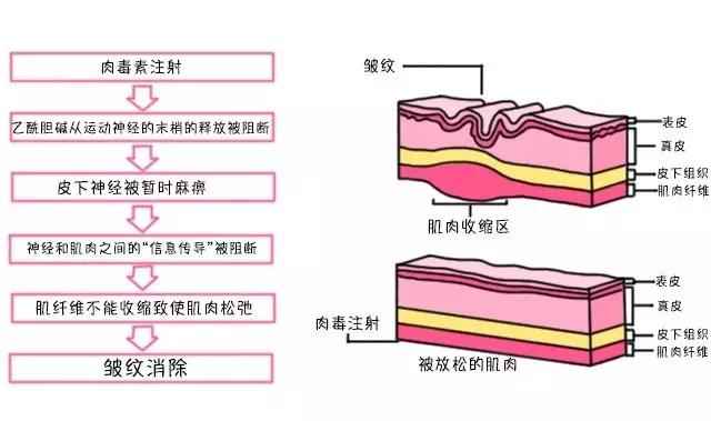 肉毒毒素除皱原理