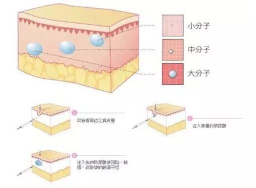 北京美天玻尿酸科普