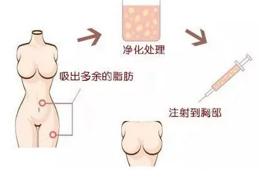 北京美天自体脂肪丰胸